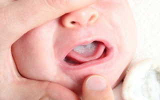 Стоматит у новорожденных во рту