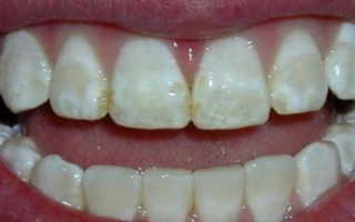 Флюороз зубов у детей и взрослых