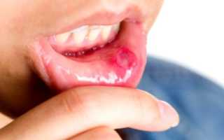 Лечение стоматита во рту у взрослых в домашних условиях
