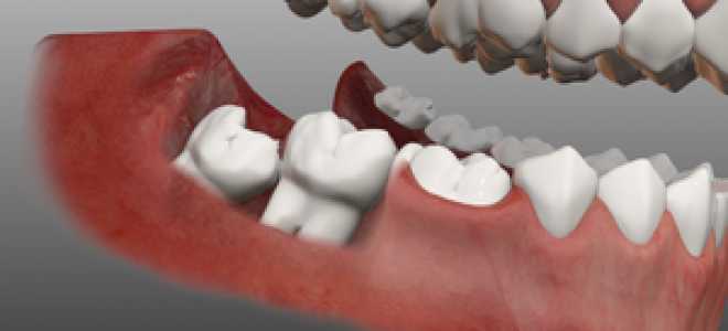 Дистопированного ретенированного зуб