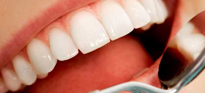 Профессиональное и самостоятельное отбеливание зубов