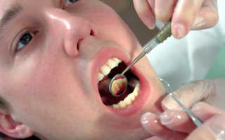 Как лечить кисту на зубе