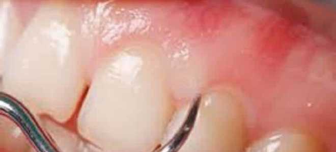 Пародонтоз как лечить