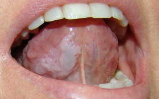 Лейкоплакия слизистой оболочки полости рта и языка