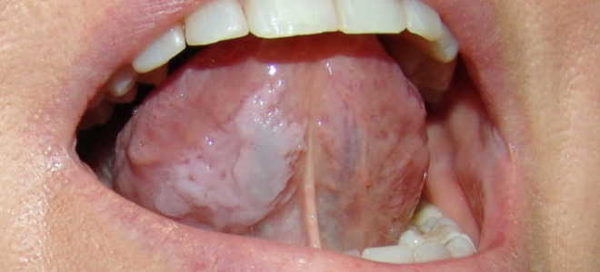Как лечить лейкоплакию полости рта