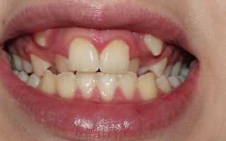 Сверхкомплектный зуб у ребенка