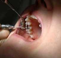 Пульсирующая боль после удаления зуба