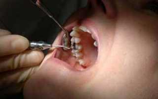 Пульсирующая боль после удаления зуба