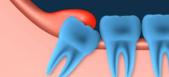 Удаление восьмого зуба снизу