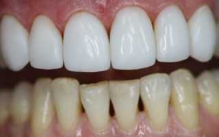 Методы и этапы художественной и эстетической реставрации передних зубов