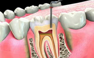Болит зуб после удаления нерва и пломбирования каналов