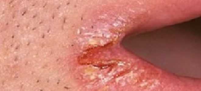 Заеды у взрослых