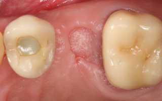 Уход за полостью рта после удаления зуба