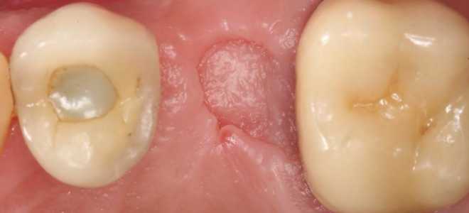 Уход за полостью рта после удаления зуба