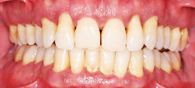 Причины возникновения пародонтоза