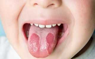 Пятна и налет на языке у детей и грудничков