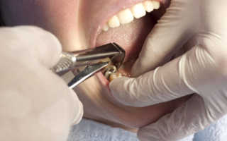 Способы лечение альвеолита после удаления зубов