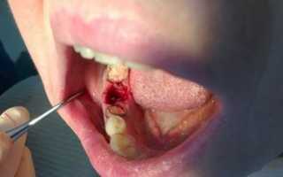 Какое лекарство закладывают в лунку после удаления зуба