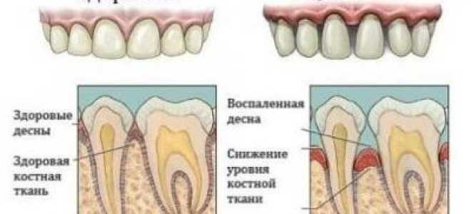 Чем лечить пародонтоз