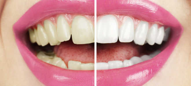 Мгновенное отбеливание зубов