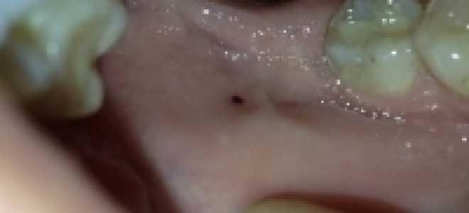 Черные точки во рту на щеке