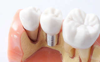 Виды имплантов для зубов от разных производителей
