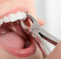 Что нужно делать после удаления зуба