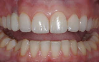 Реставрация передних зубов пломбировочным материалом