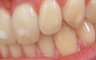 Белые пятна на зубах у взрослых и детей