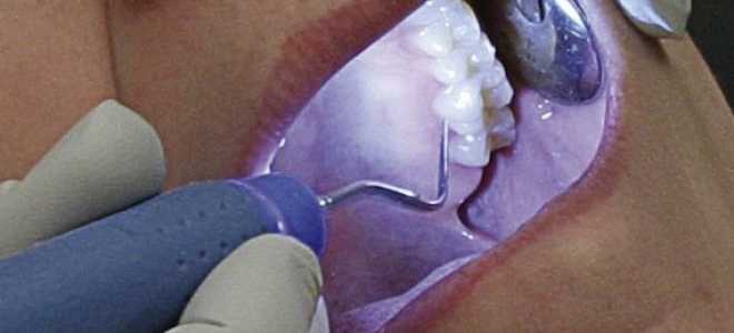 Ультразвуковая чистка зубов