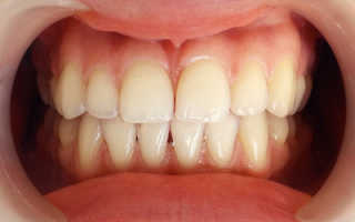 Средства для отбеливания зубов которые работают