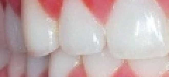 Воспаление десны причины