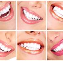 Что нельзя делать после отбеливания зубов