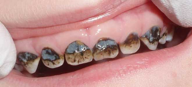 Посеребрение молочных зубов