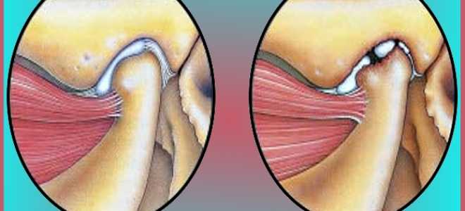 Как лечить артрит челюстного сустава