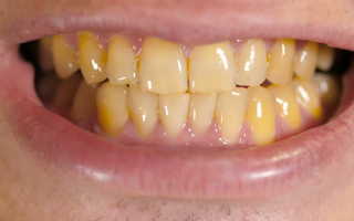 Желтый налет на зубах