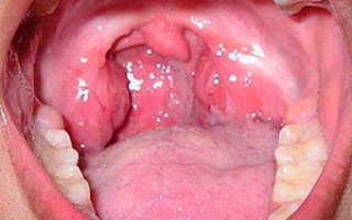 Бактериальная ангина у детей симптомы и лечение