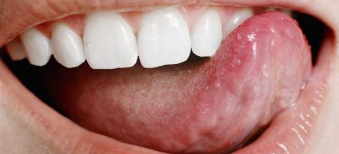 Типун на языке чем лечить